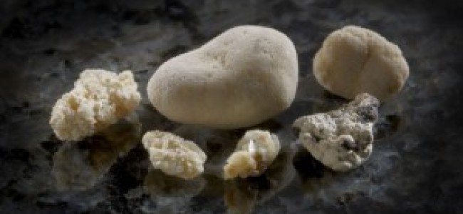 tips to help you avoid kidney stones